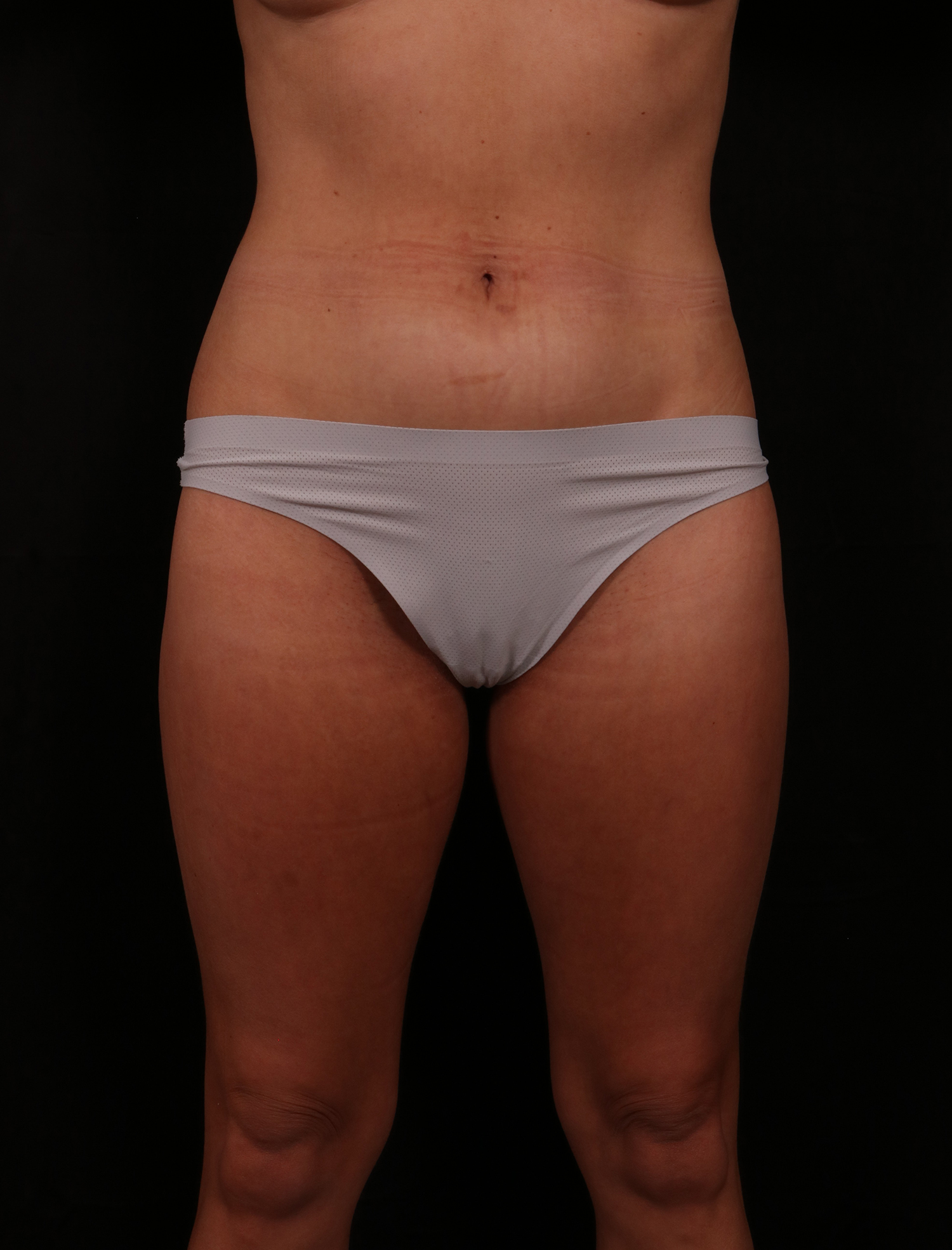 Before Image: Liposuction - front