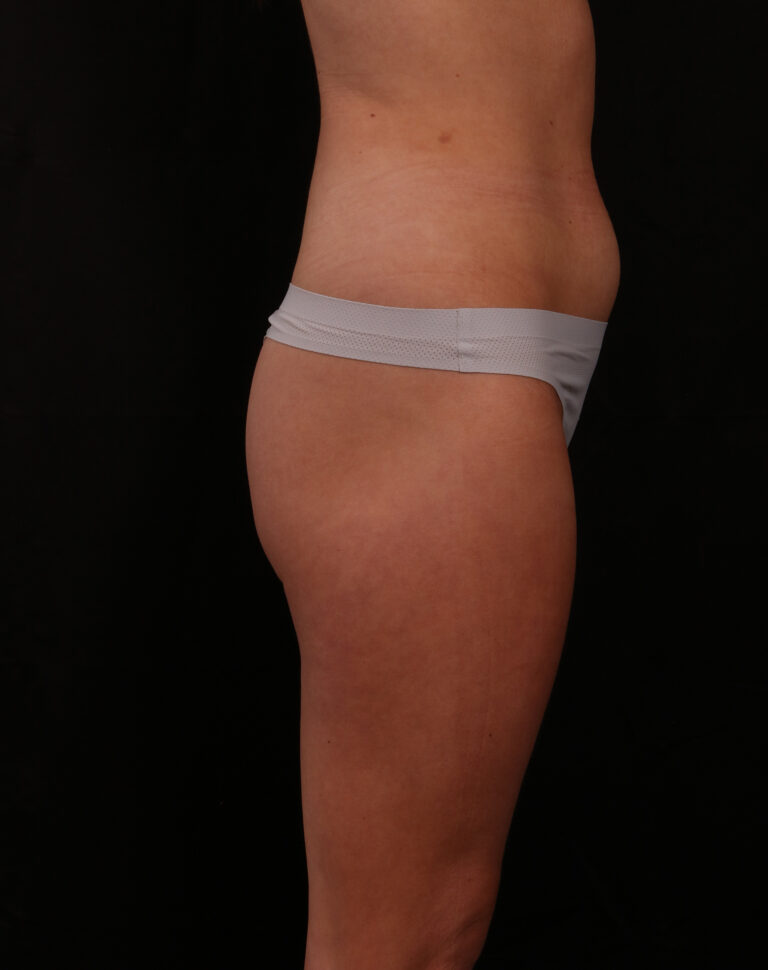 Before Image: Liposuction - right-side