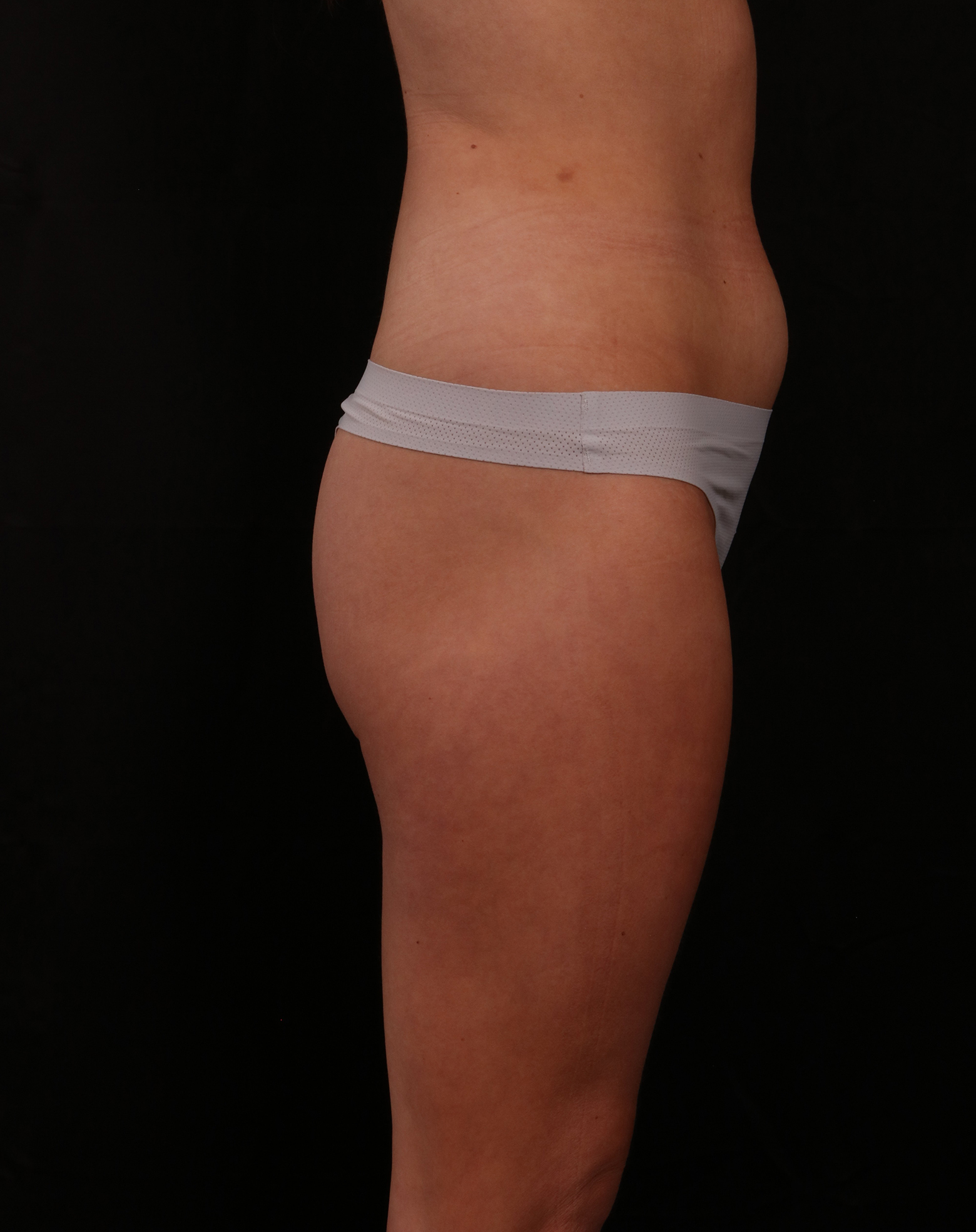 Before Image: Liposuction - right-side