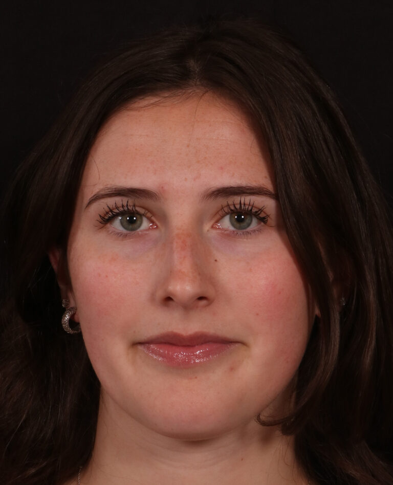 Before Image: Rhinoplasty - front