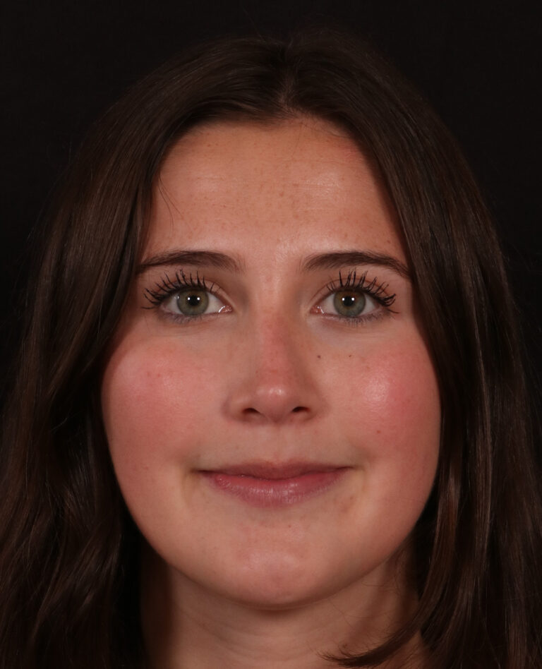 After Image: Rhinoplasty - front