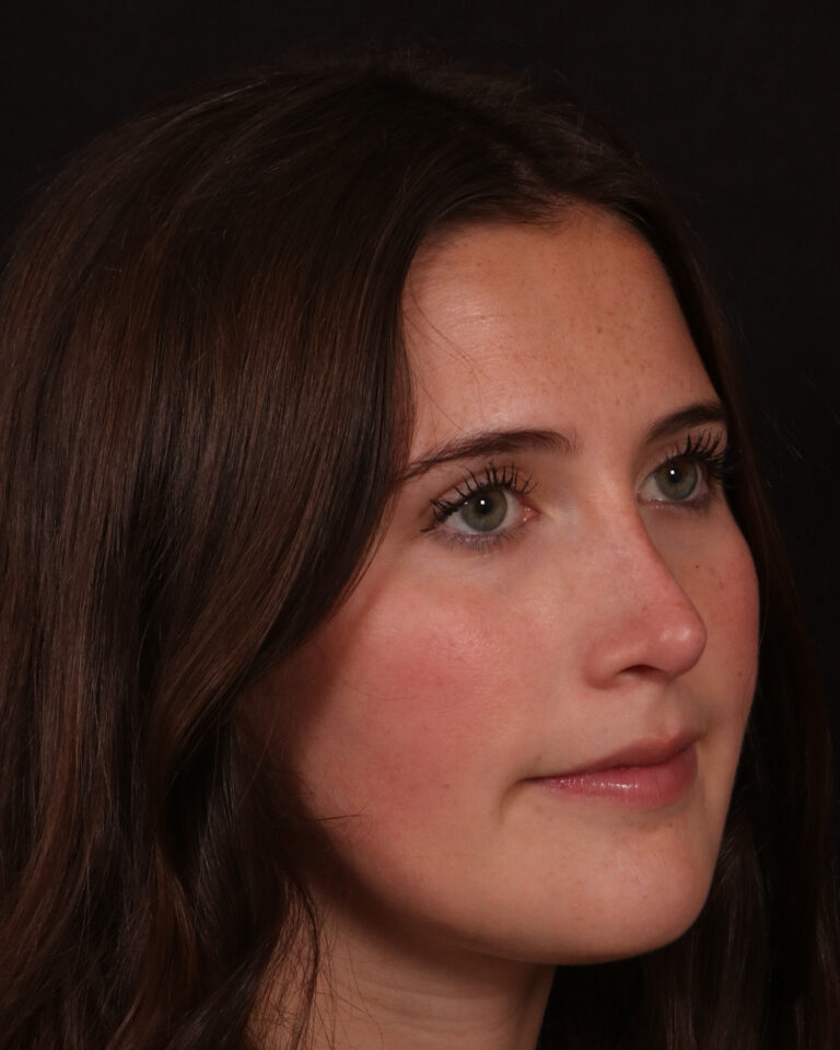 After Image: Rhinoplasty - right-front-oblique