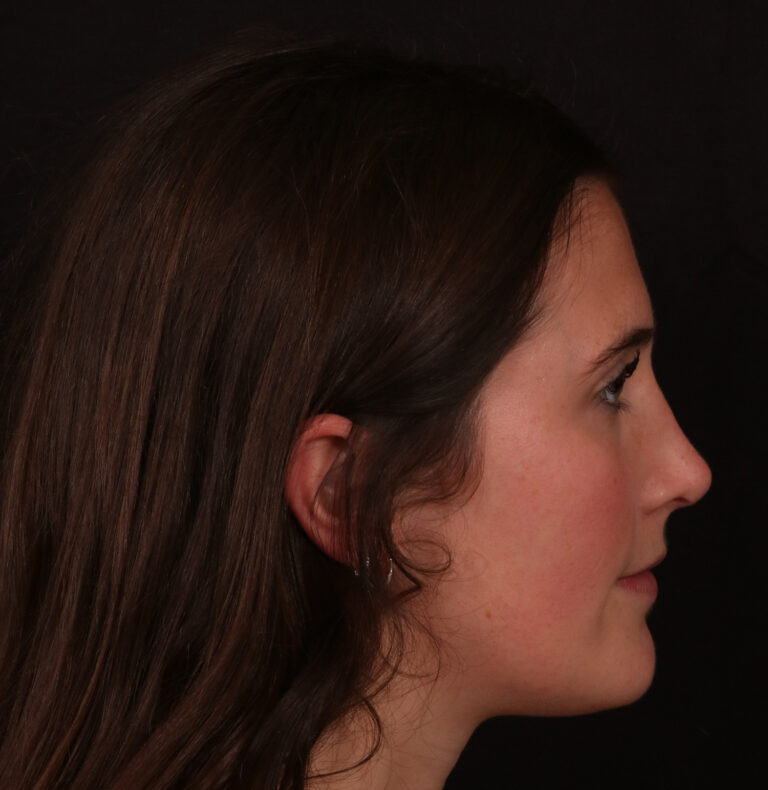 After Image: Rhinoplasty - right-side