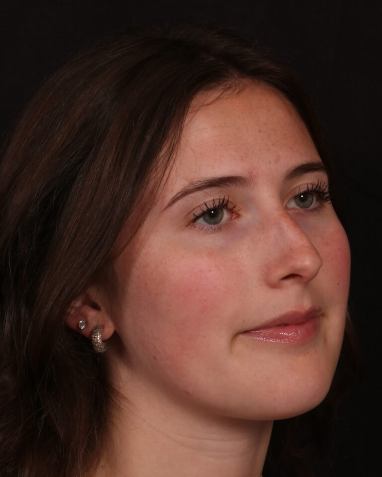 Before Image: Rhinoplasty - right-front-oblique