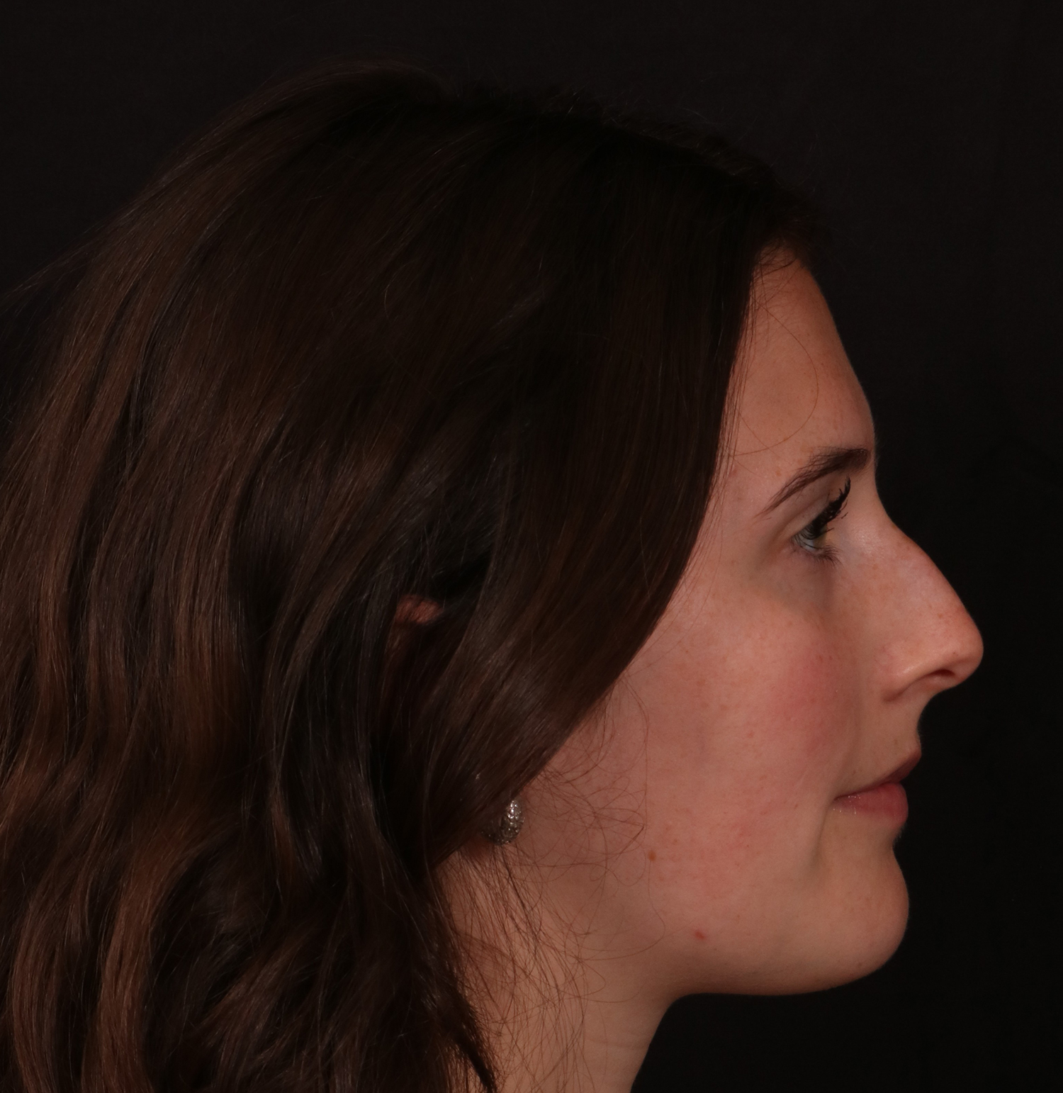 Before Image: Rhinoplasty - right-side