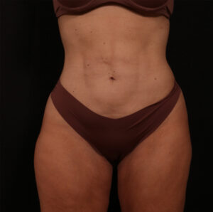 Before Image: Reverse Tummy Tuck