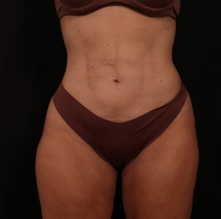 Before Image: Reverse Tummy Tuck - front