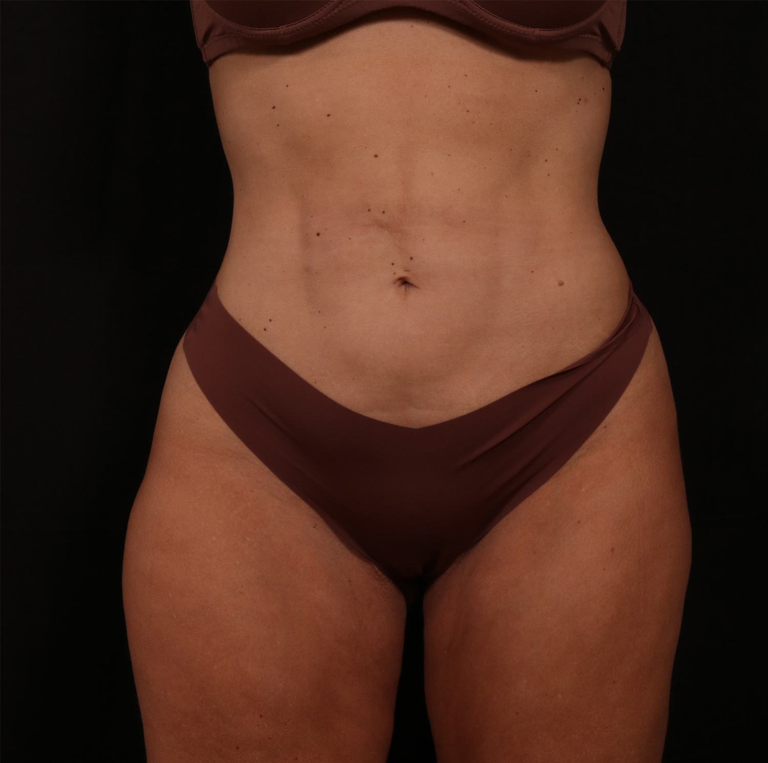 Before Image: Reverse Tummy Tuck - front
