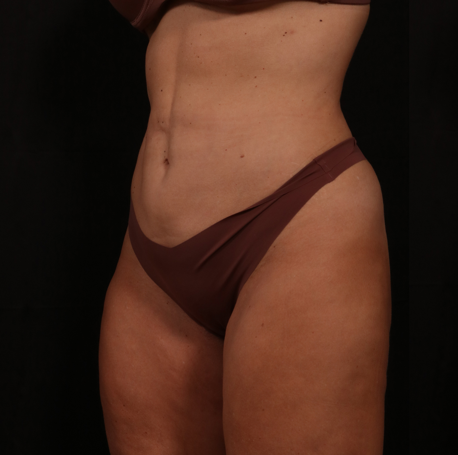 Before Image: Reverse Tummy Tuck - left-front-oblique