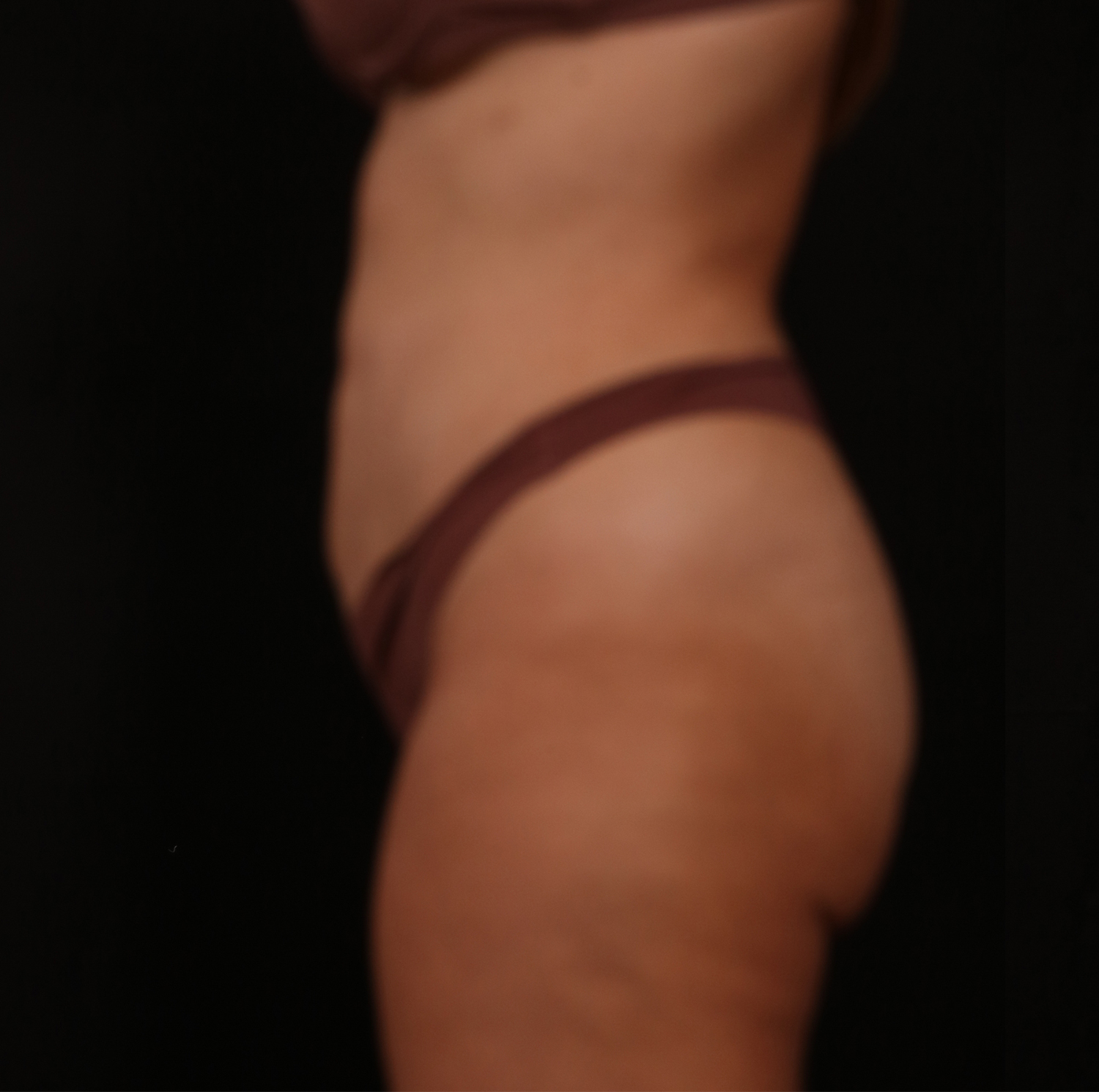 Before Image: Reverse Tummy Tuck - left-side
