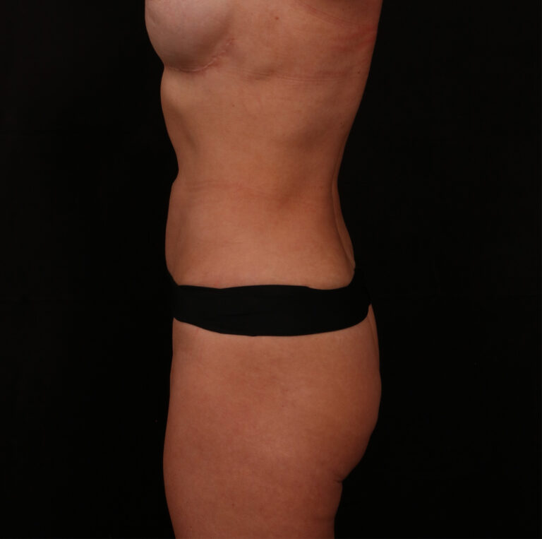 After Image: Reverse Tummy Tuck - left-side