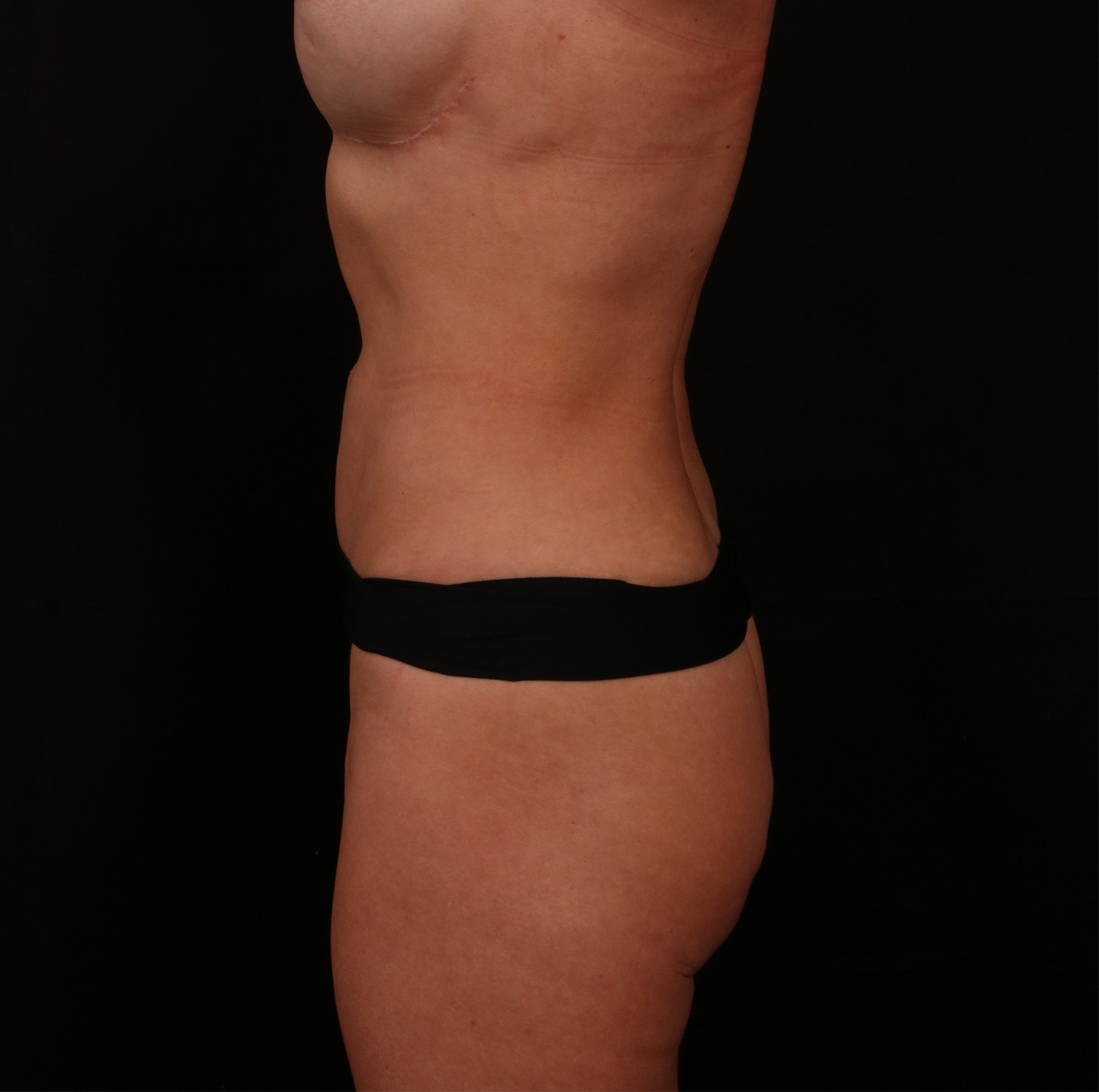 After Image: Reverse Tummy Tuck - left-side