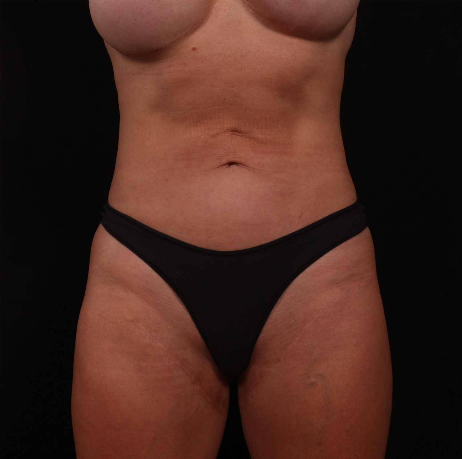 Before Image: Reverse Tummy Tuck - front