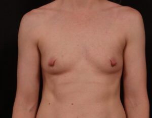 Before Image: Breast Augmentation