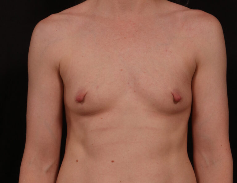 Before Image: Breast Augmentation - front