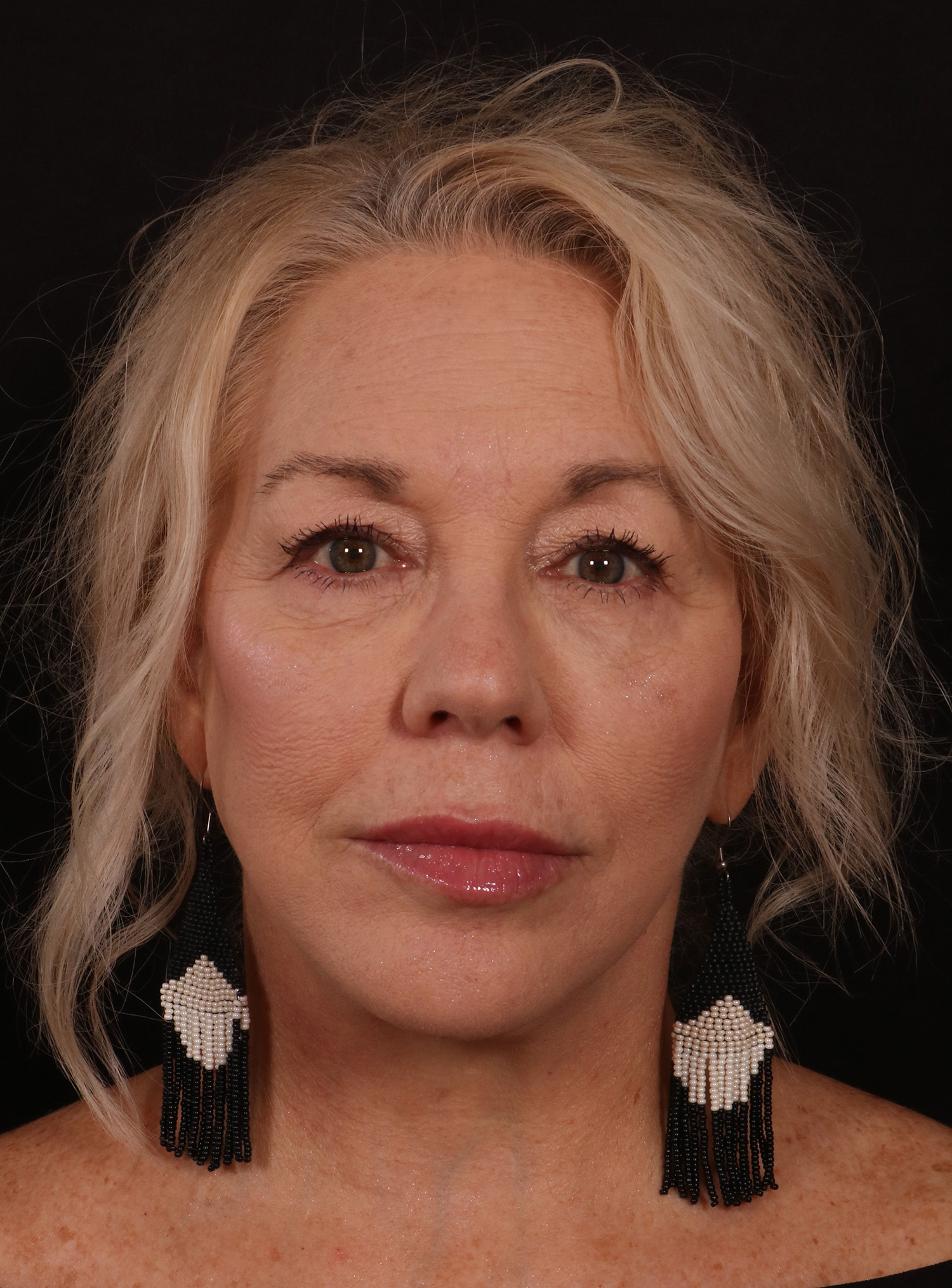 After Image: Lower Facelift / Neck Lift - front