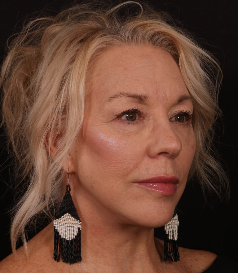 After Image: Lower Facelift / Neck Lift - right-front-oblique