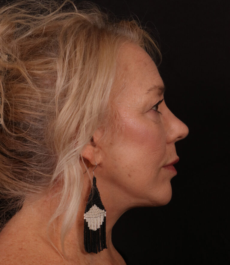 After Image: Lower Facelift / Neck Lift - right-side