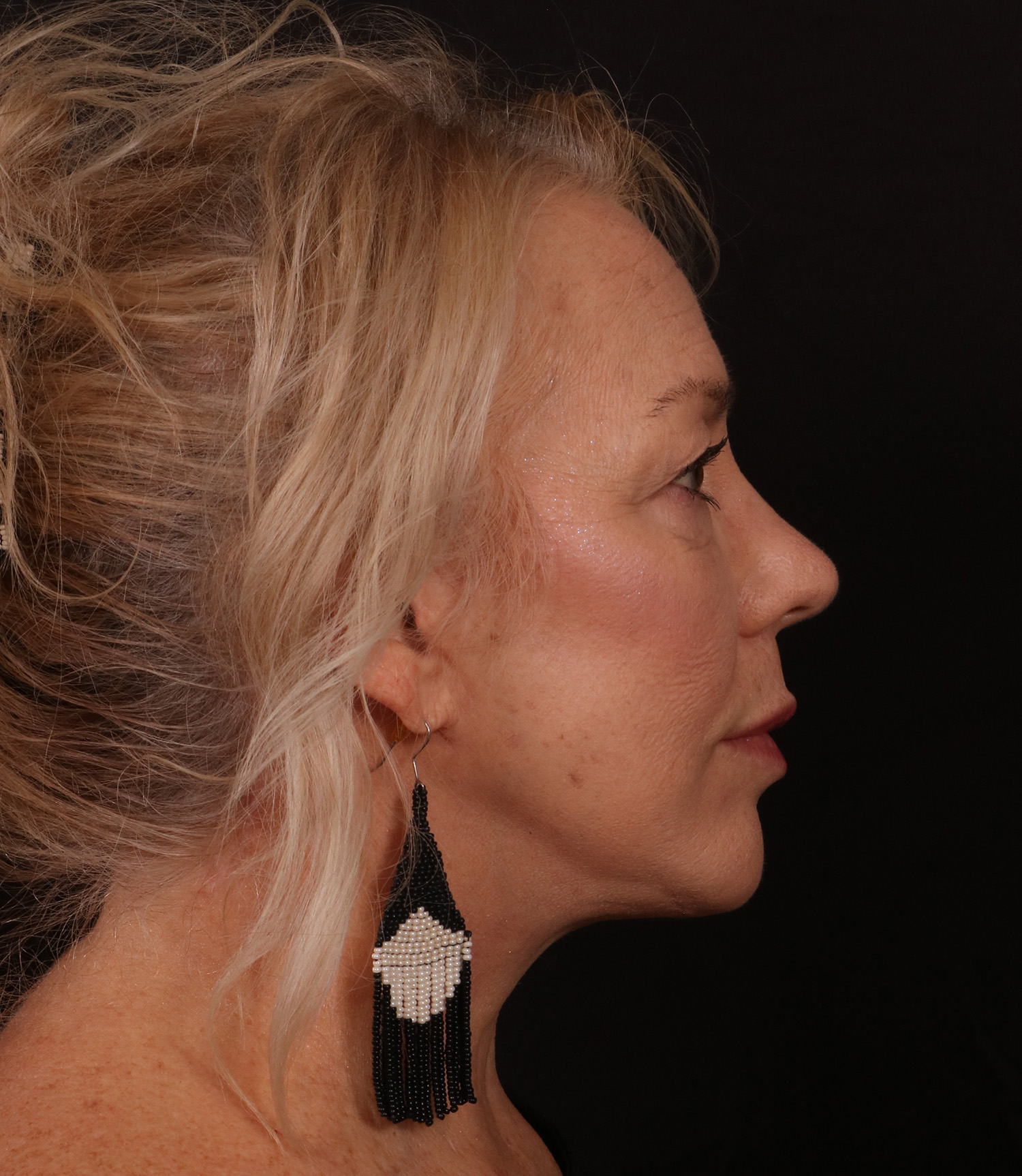 After Image: Lower Facelift / Neck Lift - right-side