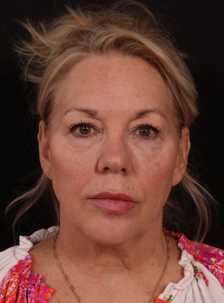 Before Image: Lower Facelift / Neck Lift - front