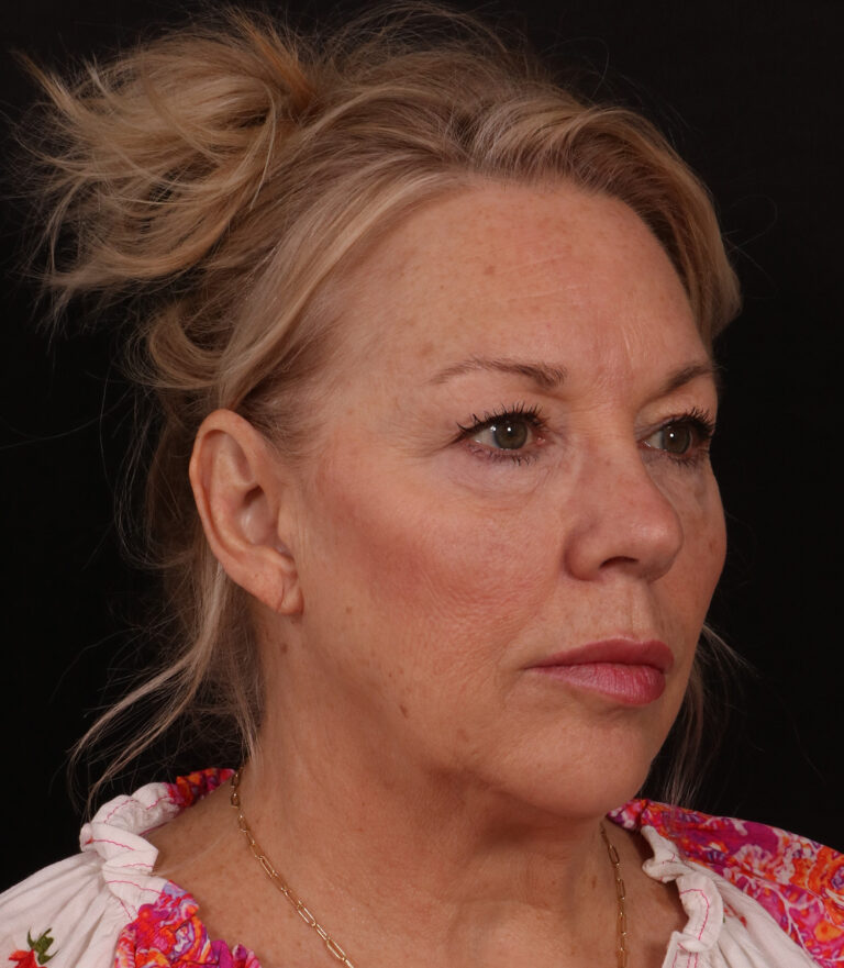 Before Image: Lower Facelift / Neck Lift - right-front-oblique