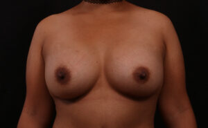 After Image: Breast Augmentation