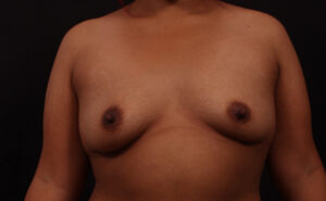Before Image: Breast Augmentation