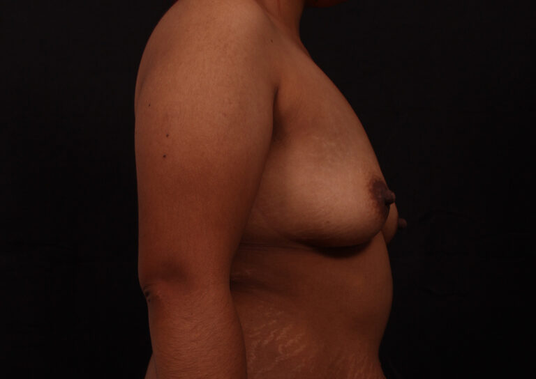Before Image: Breast Augmentation - right-side