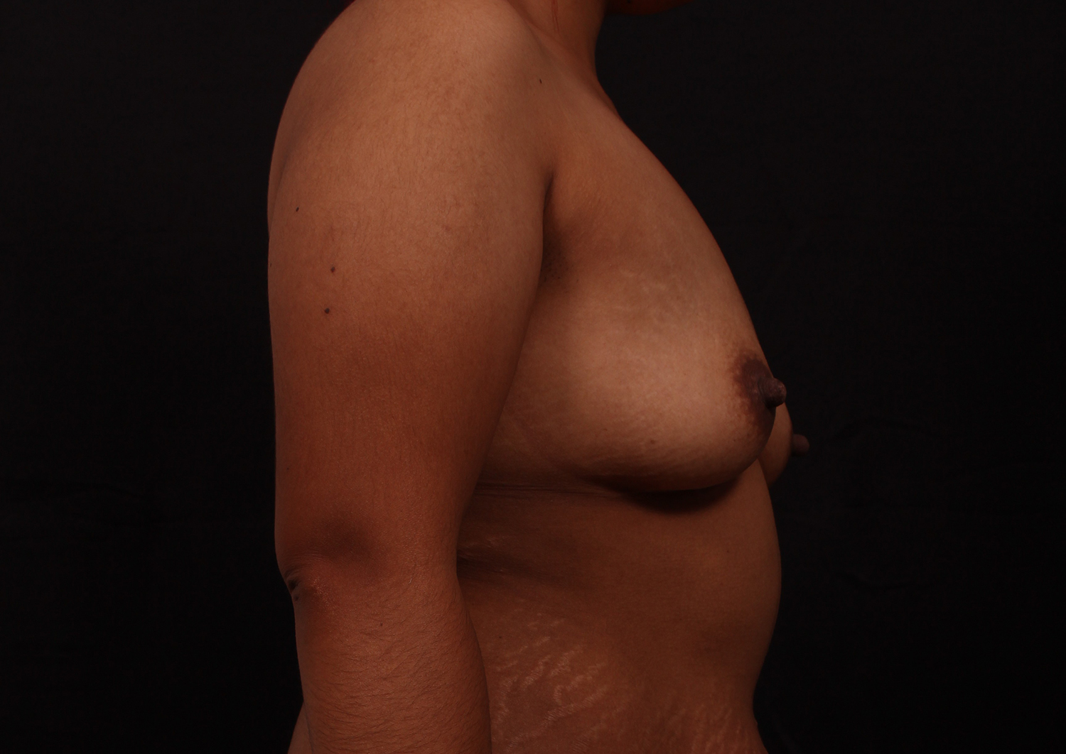 Before Image: Breast Augmentation - right-side