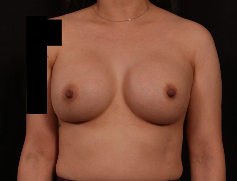After Image: Breast Augmentation - front