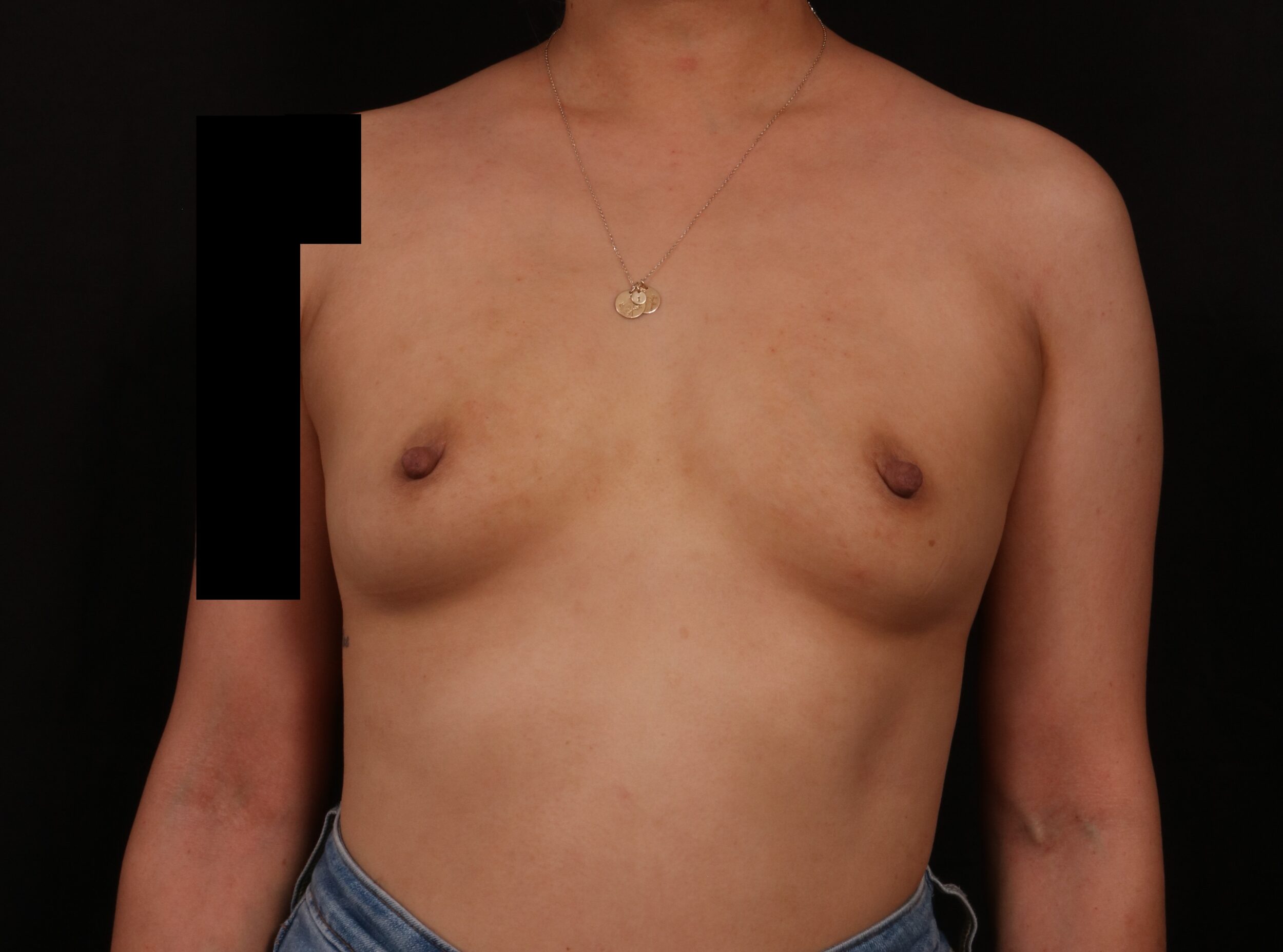 Before Image: Breast Augmentation - front