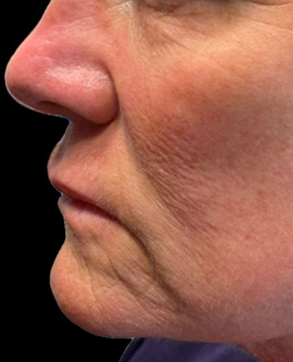 Before Image: Ultraclear + Tissue Coring - left-side