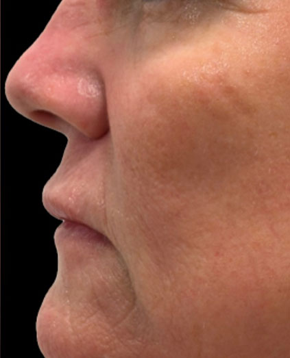 After Image: Ultraclear + Tissue Coring - left-side