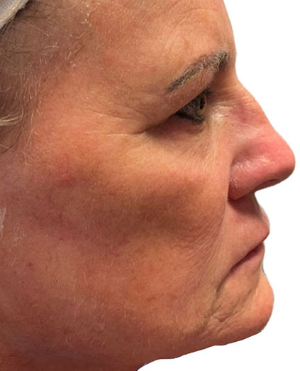 Before Image: Ultraclear + Tissue Coring - right-side