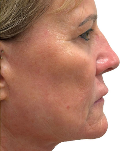 After Image: Ultraclear + Tissue Coring - right-side
