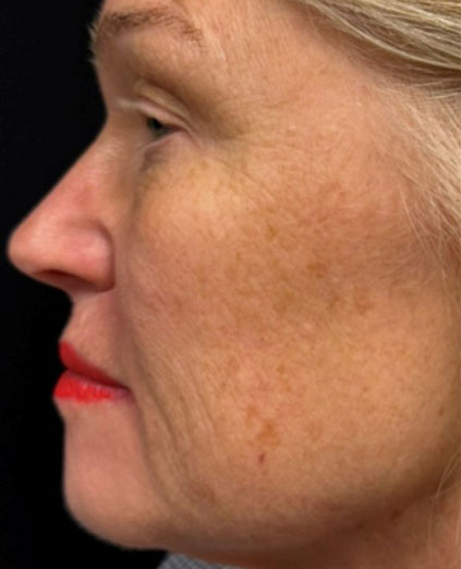 Before Image: Ultraclear + Tissue Coring - left-side