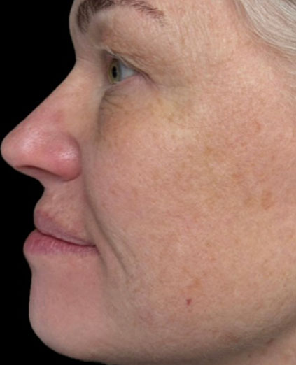 After Image: Ultraclear + Tissue Coring - left-side