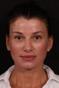 After Image: Lower face lift and temporal brow lift