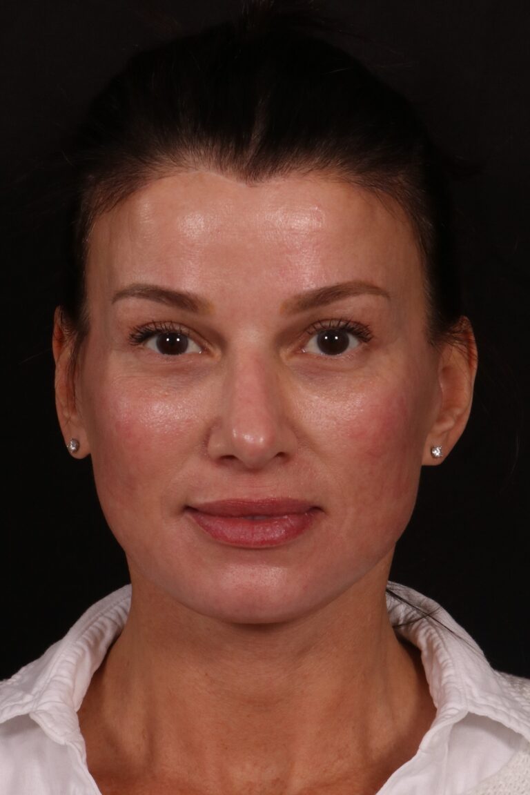 After Image: Lower face lift and temporal brow lift - front