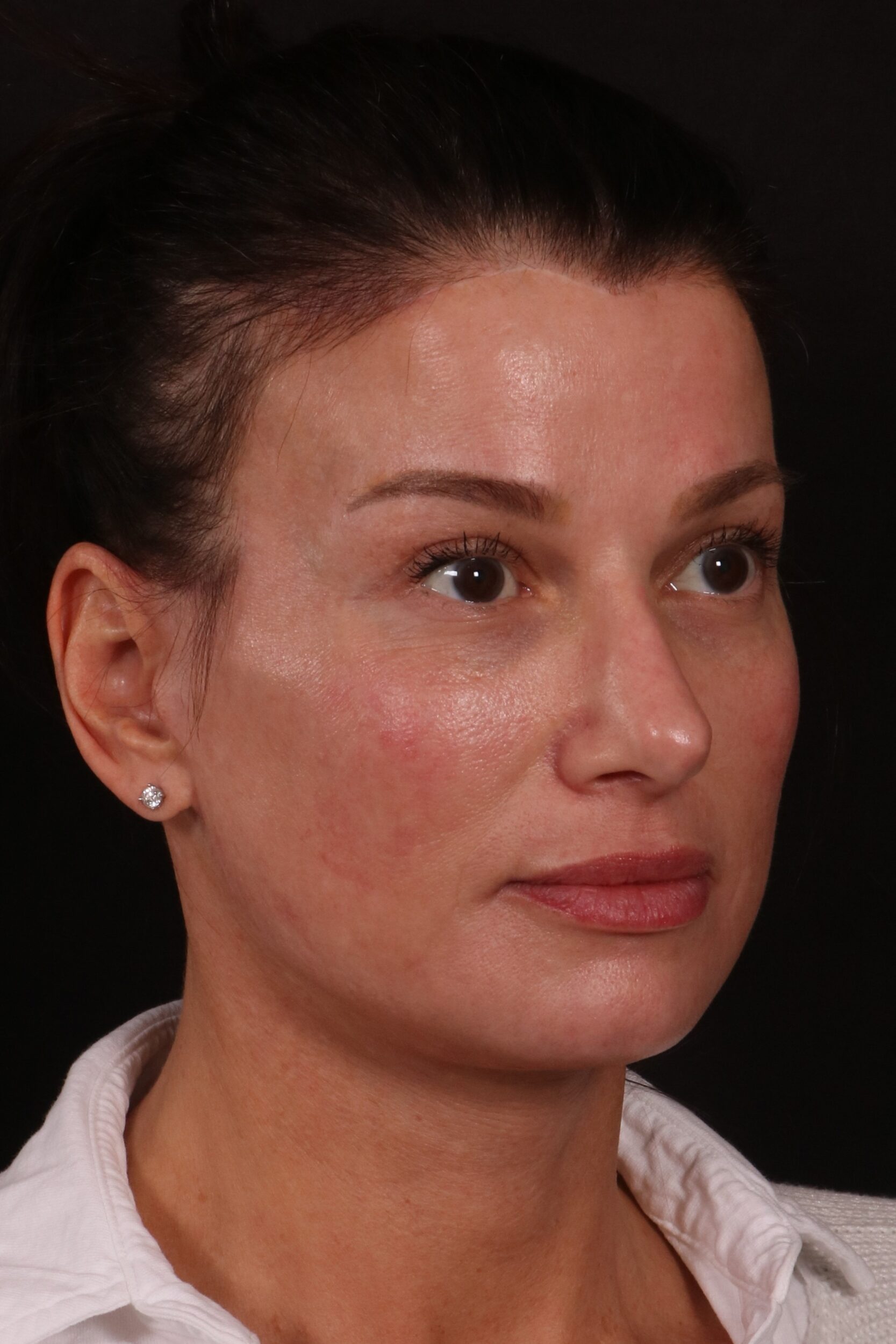 After Image: Lower face lift and temporal brow lift - right-front-oblique