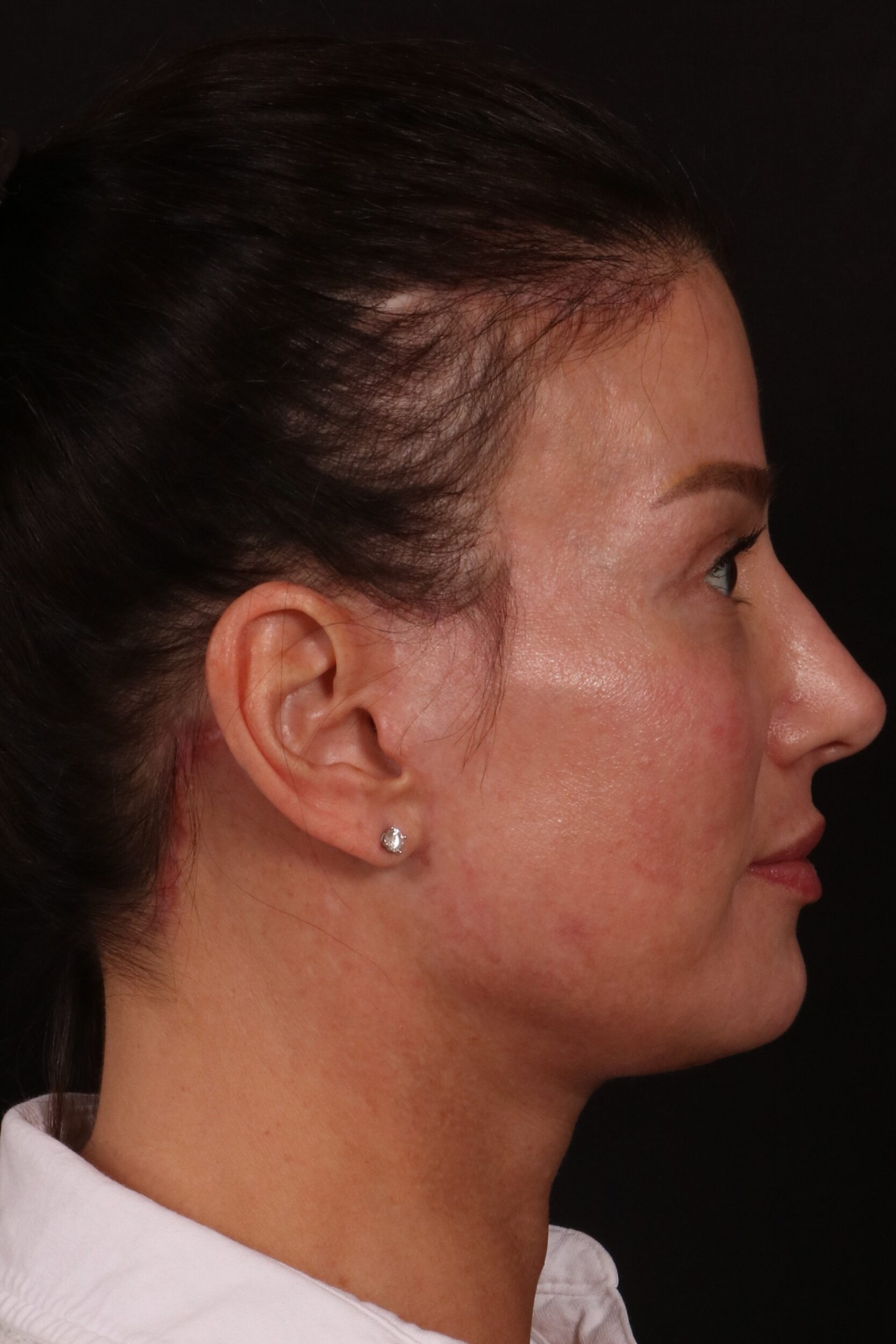 After Image: Lower face lift and temporal brow lift - right-side