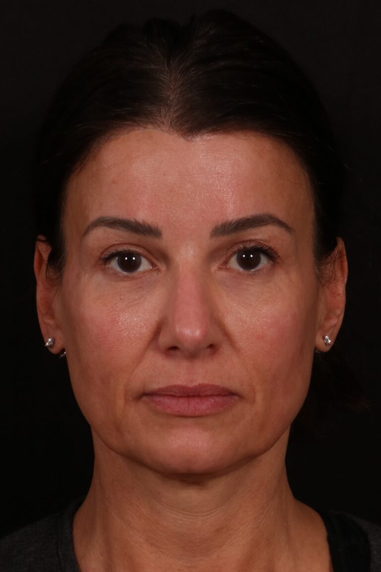 Before Image: Lower face lift and temporal brow lift - front