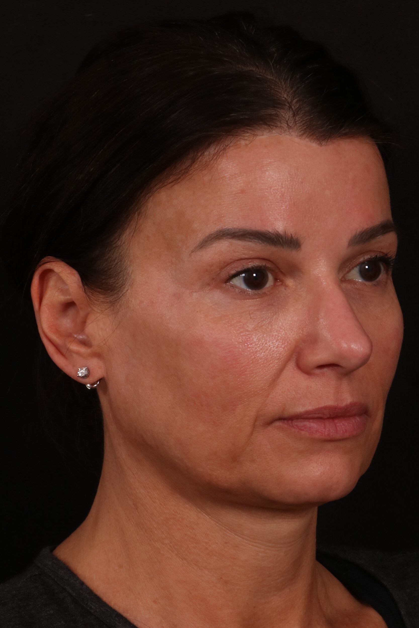 Before Image: Lower face lift and temporal brow lift - right-front-oblique