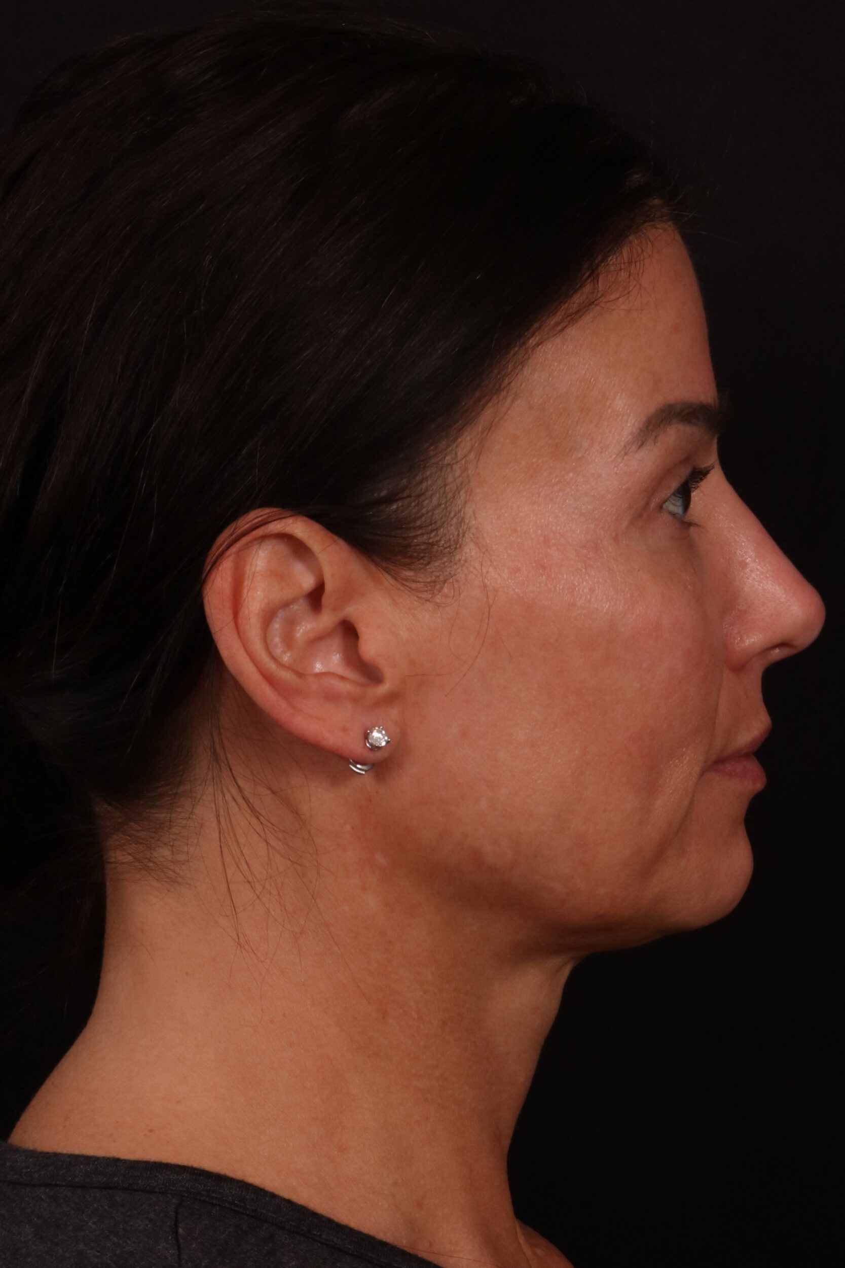 Before Image: Lower face lift and temporal brow lift - right-side