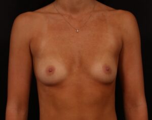 Before Image: Breast Augmentation