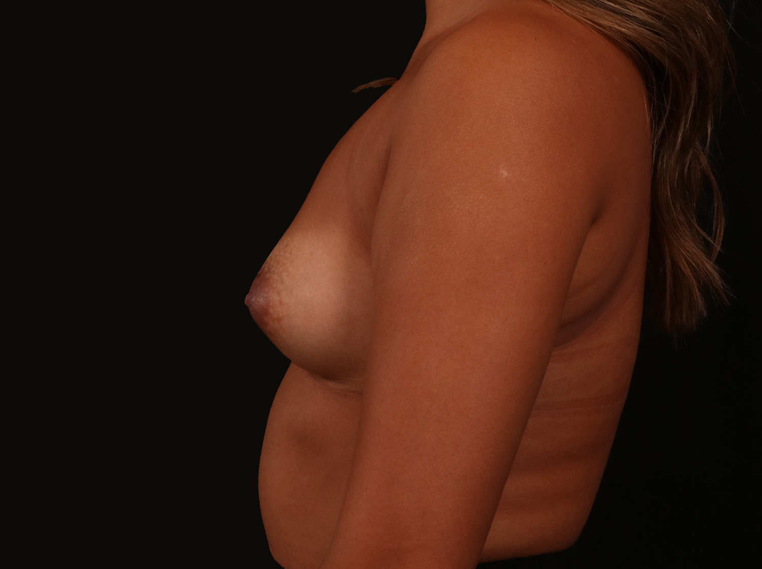 Before Image: Breast Augmentation - left-side