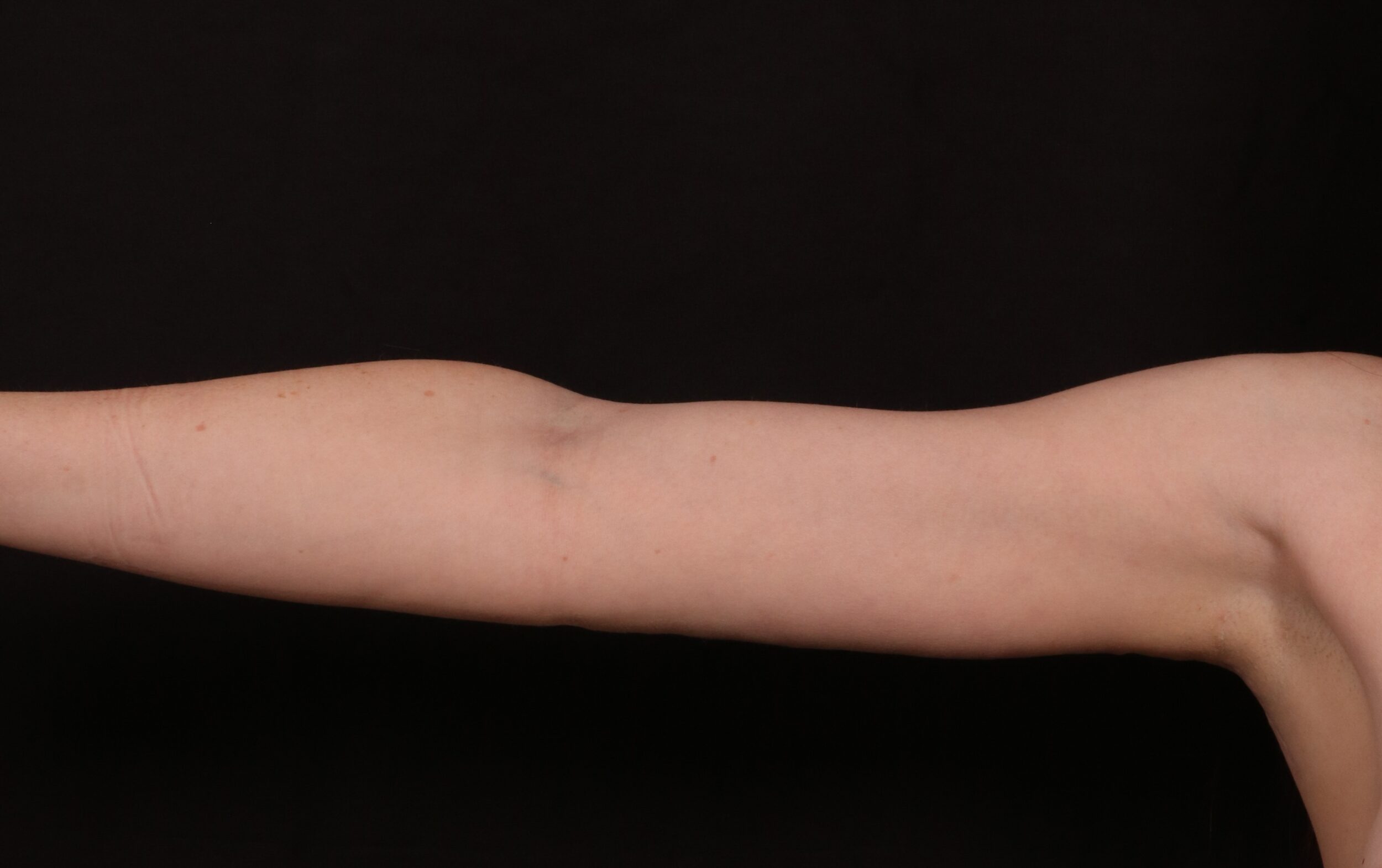 After Image: Brachioplasty - front