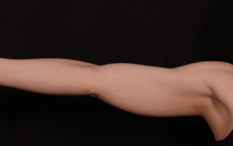 Before Image: Brachioplasty - front