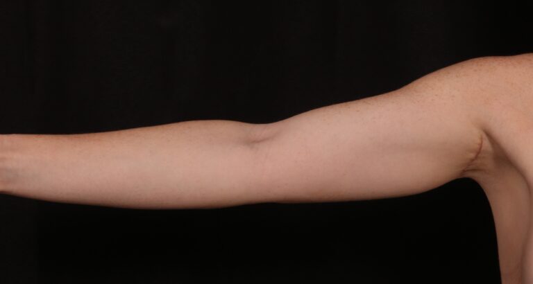 After Image: Brachioplasty - front