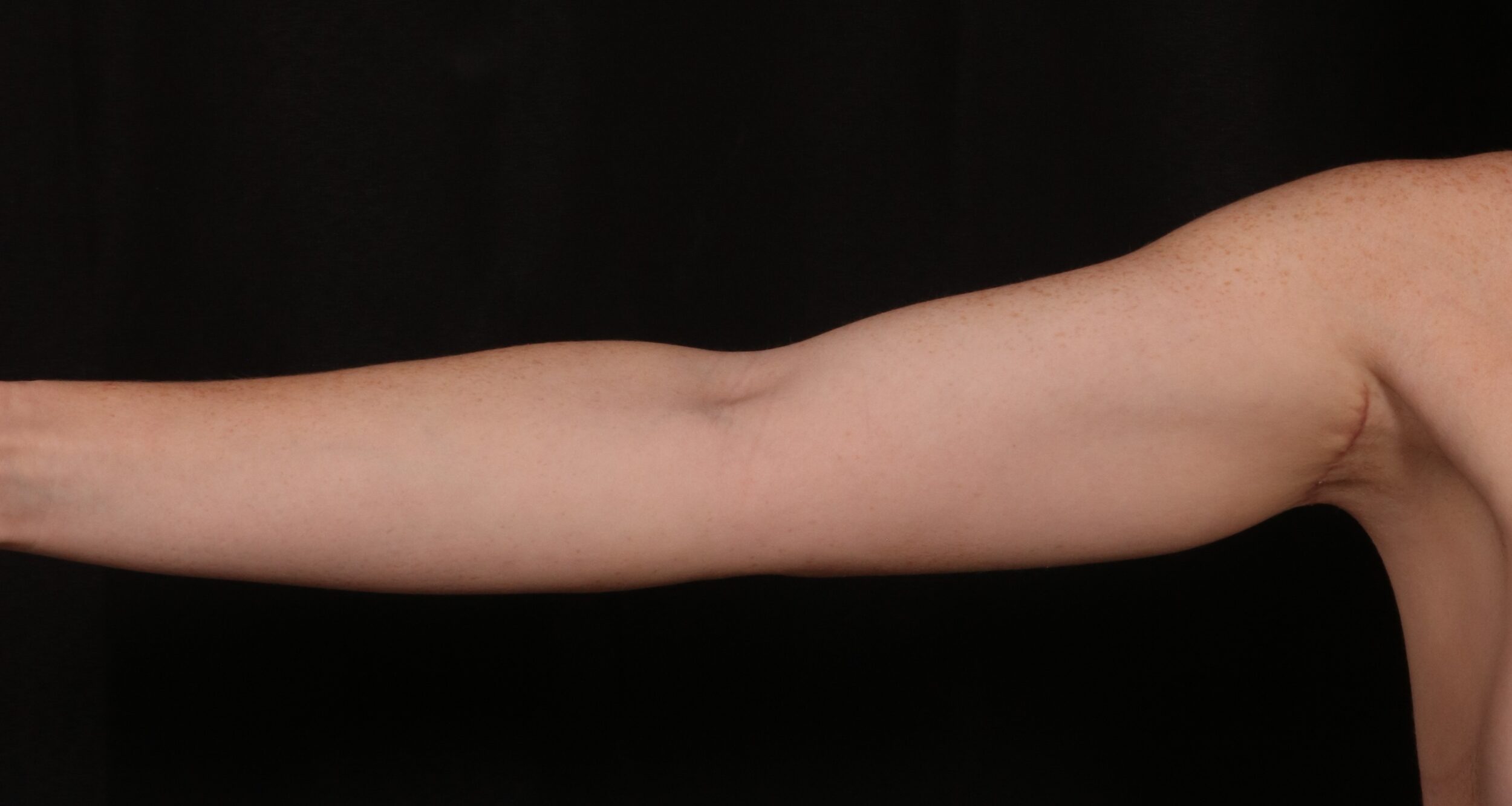 After Image: Brachioplasty - front